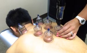 Cupping Performed at 1st Choice Sports Rehab